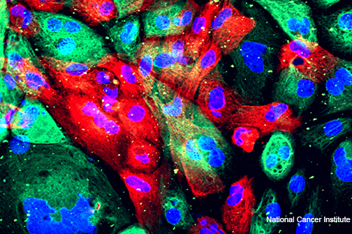 prostate cancer cells